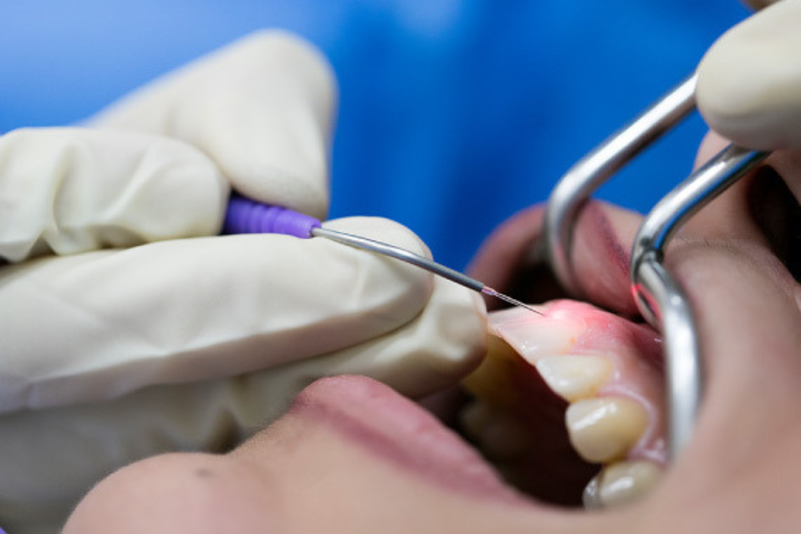 Smile correction dentist in Bachupally