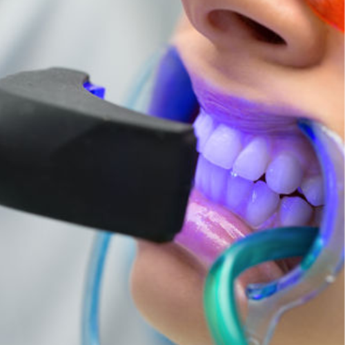 Laser dental treatment in Bachupally – advanced painless dentistry