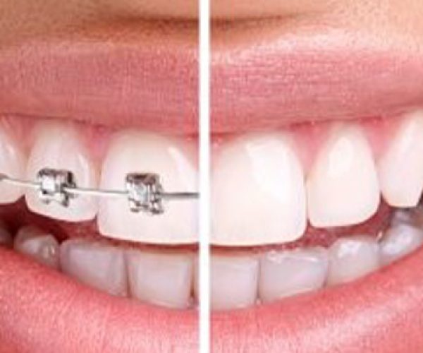 aligners,invisalign, dental bridges