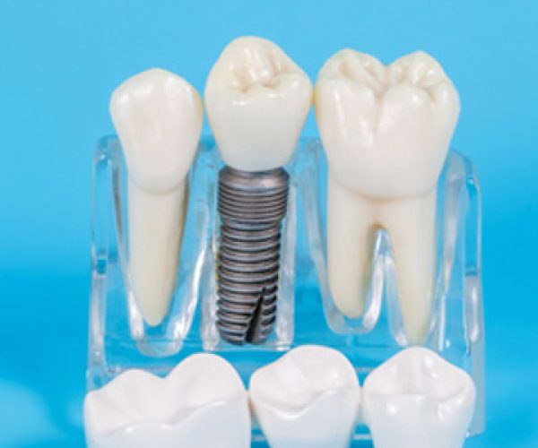 dental crowns in miyapur