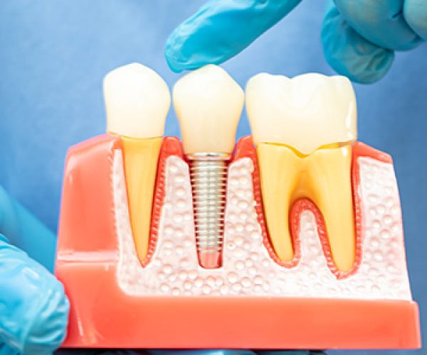 tooth replacement services in bachupally