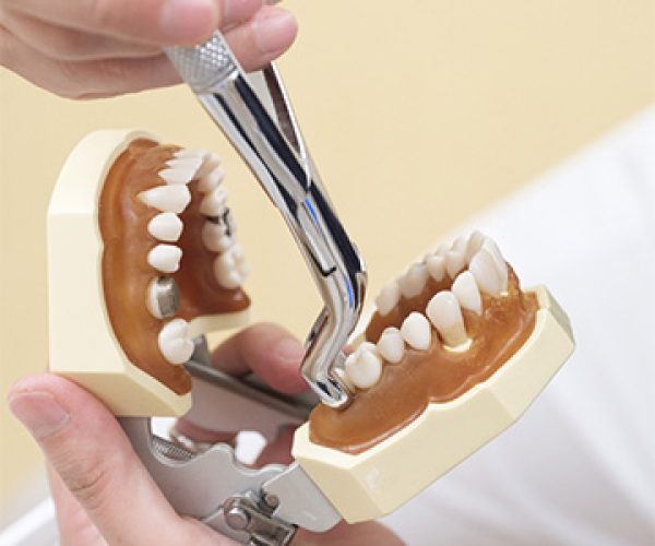 aligners,invisalign, dental bridges
