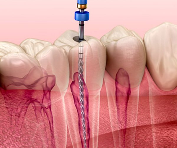 root canal treatment in bachupally