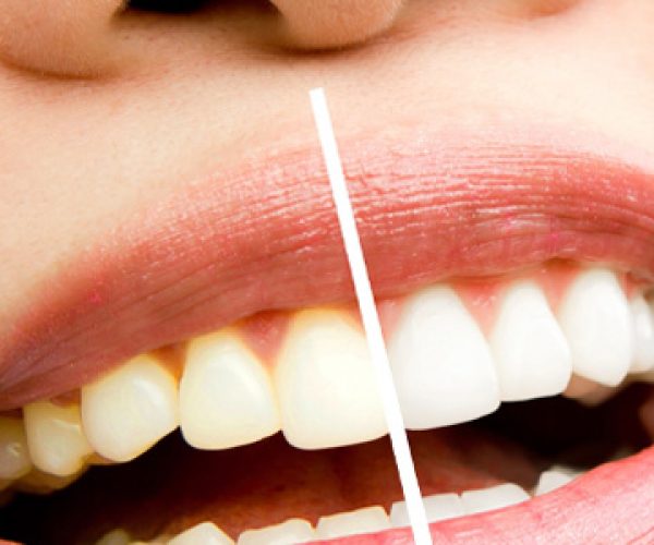cosmetic dental services in bachupally